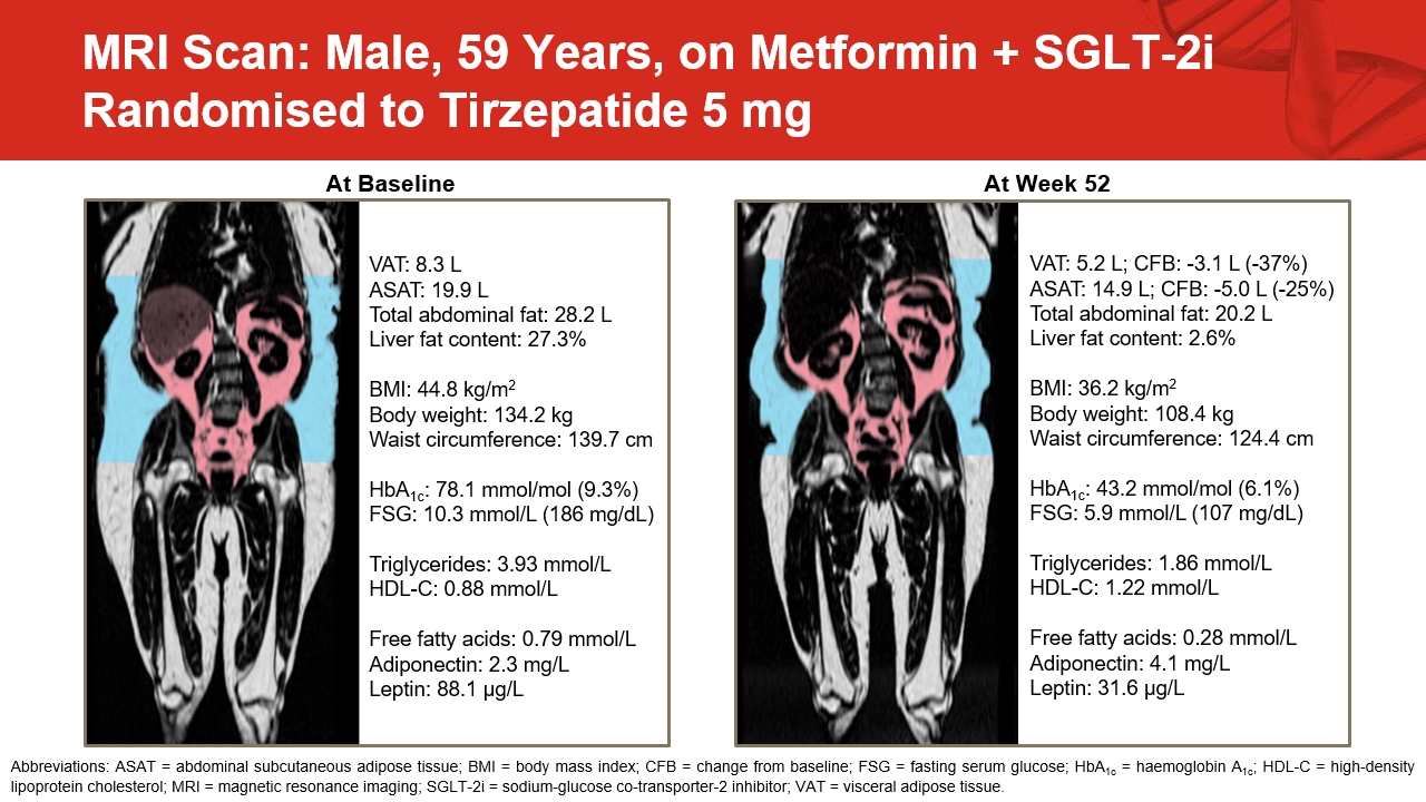 treatment options after tirzepatide weight loss Can Tirzepatide Help You Lose Weight?